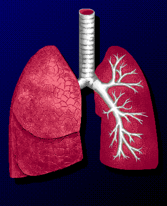 Lobectoma pulmonar