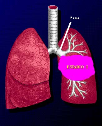 etapa 2 del cancer de pulmon